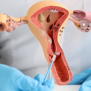 Salpingite: infiammazione delle tube di Falloppio e infertilità
