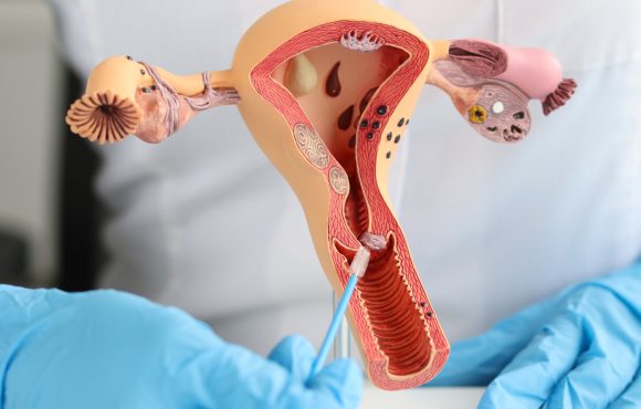 Salpingite: infiammazione delle tube di Falloppio e infertilità